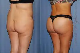 example of a woman 50yo with a low butt crack