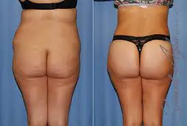 surgery on woman for a low butt crack