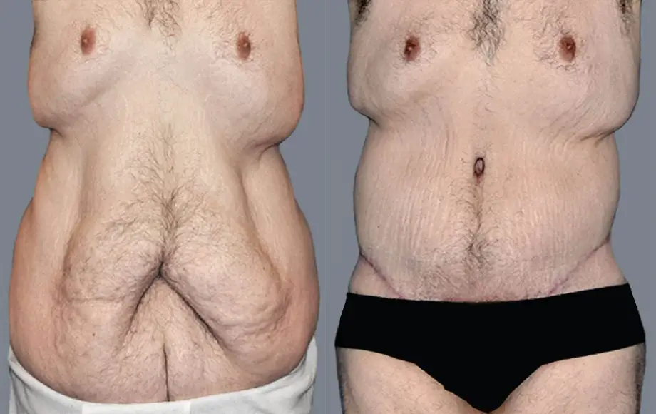 man showing How To Tell The Difference Between Fat And Loose Skin