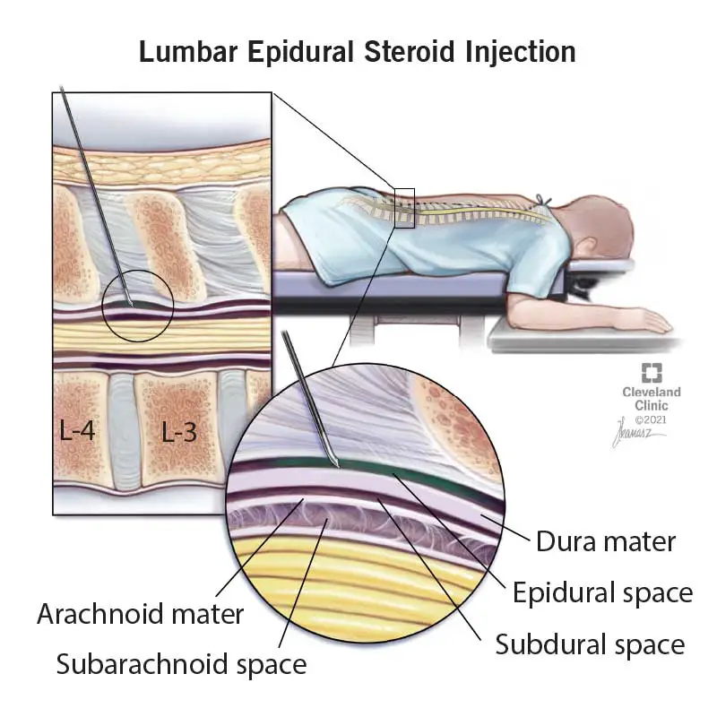 Lumbar-EpiduralSteroid Injection explained by a doctor