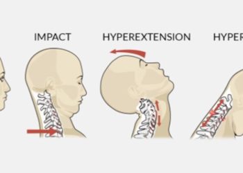 Why Do I Get Lightheaded When I Stretch neck full explain