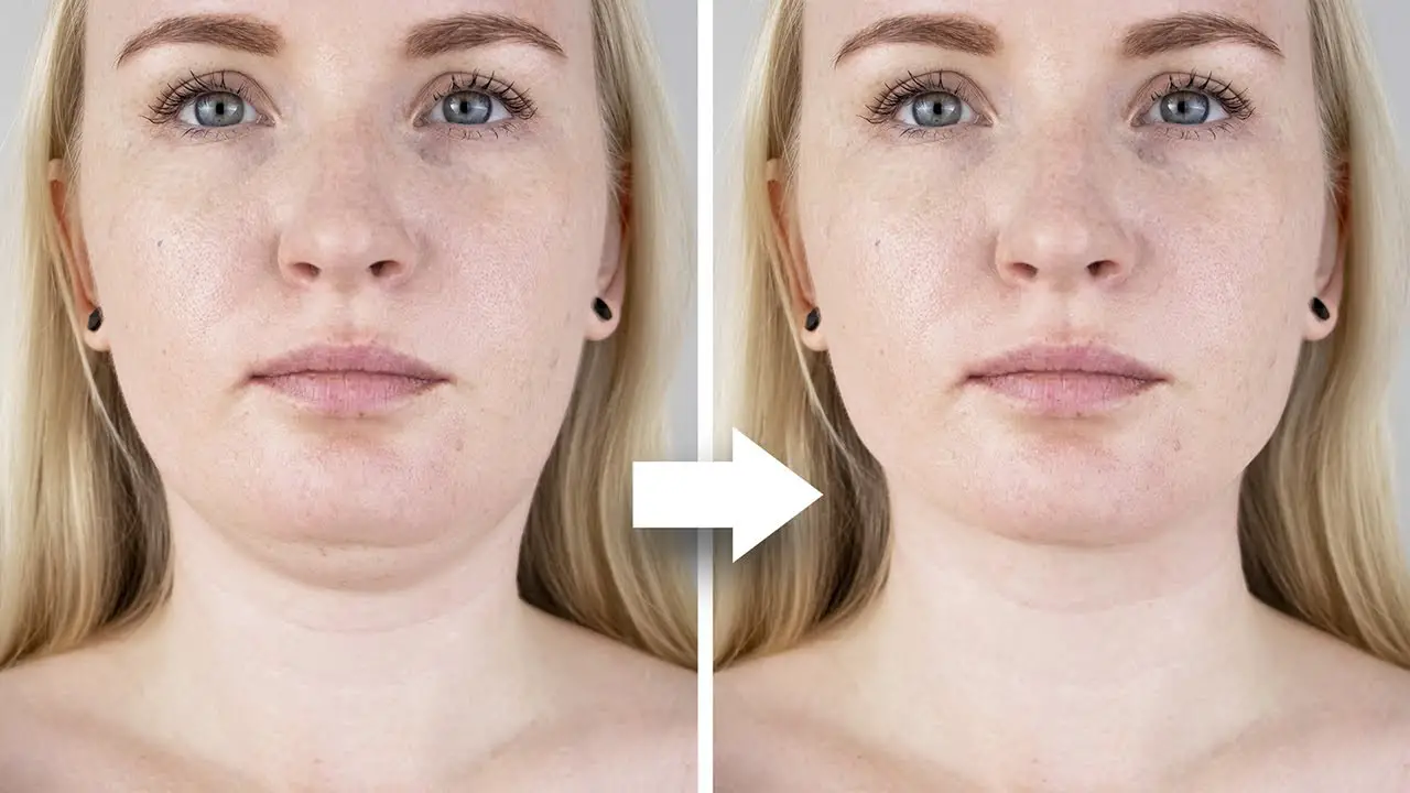 woman before and after removing double chin