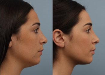 woman side view with a double chin because of excess fat