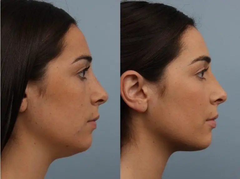 woman side view with a double chin because of excess fat