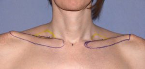 Surgery to Make Shoulders Less Broad
