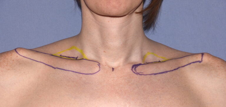 Surgery to Make Shoulders Less Broad