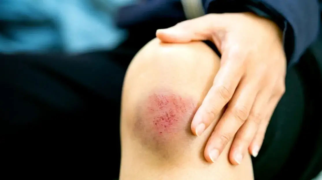 can you exercise with a bone bruise